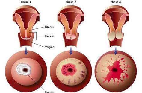 Semne Ale Cancerului Uterin Pe Care Femeile Nu Ar Trebui Sa Le Ignore