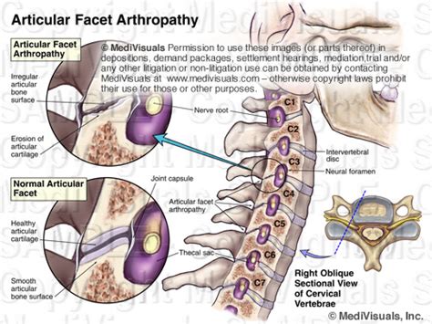 Medical Exhibits - Demonstrative Evidence Expert Blog - MediVisuals | facet arthropathy