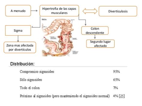 Diverticulitis Diverticulo De Meckel