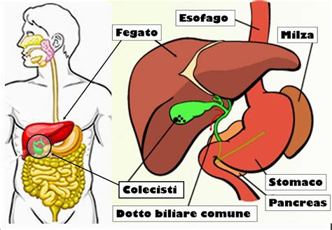 CALCOLI DELLA COLECISTI E COLECISTITE