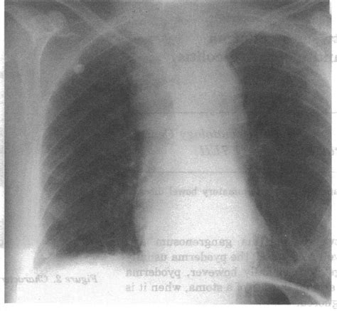 Posterior Anterior Chest X Ray Dernonstrating Superior Mediastinal