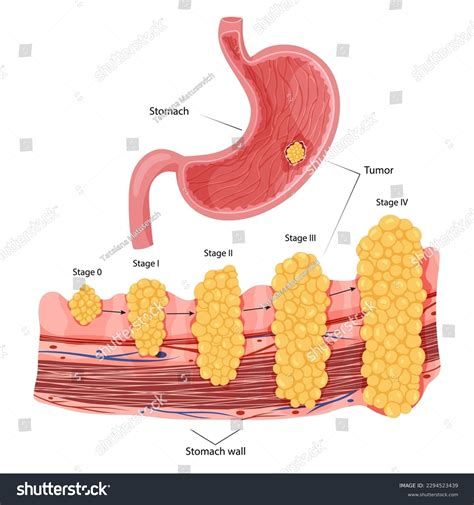 Stomach Cancer Stages Growth Malignant Cancerous Stock Vector Royalty