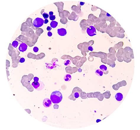 Bone Marrow Study Microscopically Show Megakaryocytes Megakaryocytic