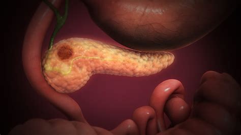 New Strategies Against a Hard-to-Treat Killer — Pancreatic Cancer ...