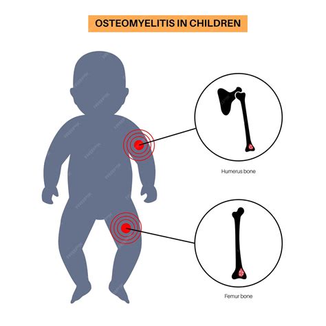 Enfermedad De Osteomielitis En Niños Casos Comunes Huesos Infectados De