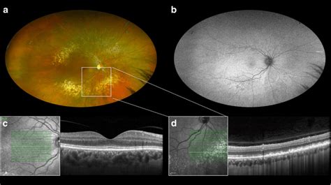 Multimodal Imaging Evaluation Of A Year Old Female With Large