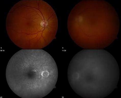 Ophthalmic Manifestations Cytology Immunohistochemistry And Molecular Analysis Of Intraocular