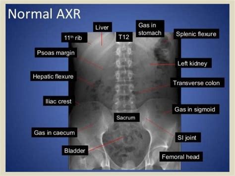 Abdominal X Ray Labeled