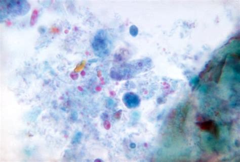 Dientamoeba Fragilis Trichrome