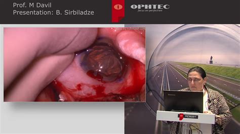 Precizon Toric Iol Challenging Cases From Prof Merab Dvali Georgia