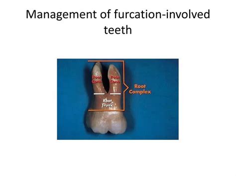 Ppt Management Of Furcation Involved Teeth Powerpoint Presentation