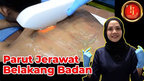 Rawatan Parut Jerawat Belakang Badan AFT Laser Ligth Skin Centre