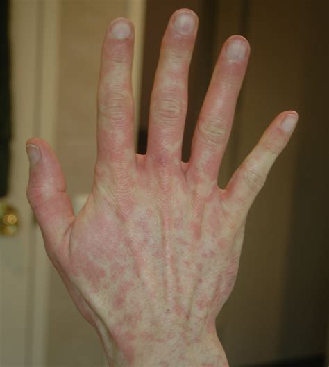 Itchy Rash On Hands Only At Luis Spence Blog