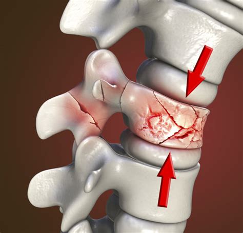 Spinal Fracture - Texas Back Institute