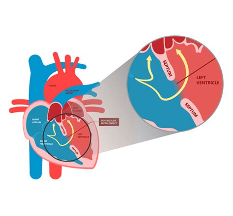 Ventricular Septal Defect Smt