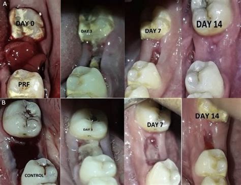 Day By Day Tooth Extraction Healing Stages With Pictures 2023 Go Fix Teeth