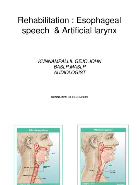 Rehabilitation Esophageal Speech And Artificial Larynx Esophagus Larynx