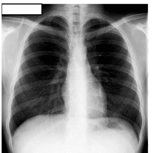 Posicionamento Radiol Gico T Rax Pa E Perfil Anatomia Papel E Caneta