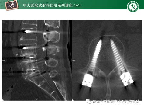 脊柱术后的影像评估放射科脊柱影像评估 健康界