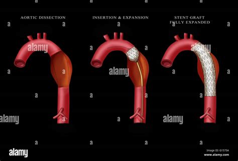 Abdominal Aortic Stent