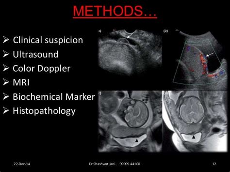 Adherent Placenta Diagnosis And Management By Dr Shashwat Jani