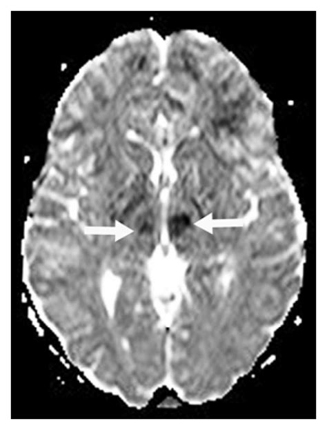 Dwi A And C And Adc Map B And D Of Different Patients Patient