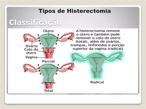 Histerectomia Cuidados De Enfermagem Ppt