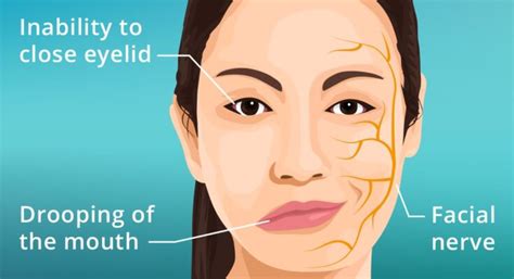 Bells Palsy Diagnosis And Treatment