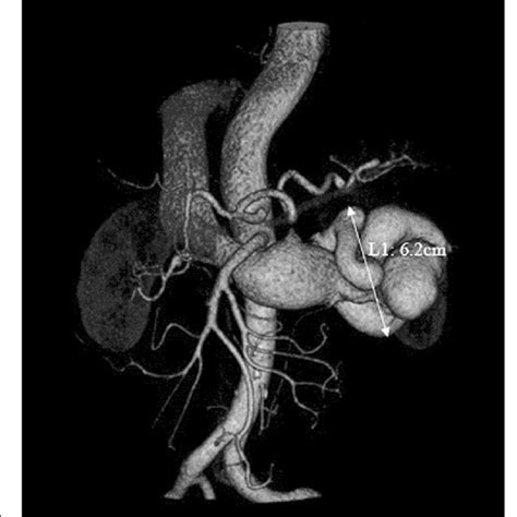 Pre Operative Three Dimensional Computed Tomography D Ct