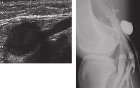 Note the remarkable enlargement of the proximal small saphenous vein ...