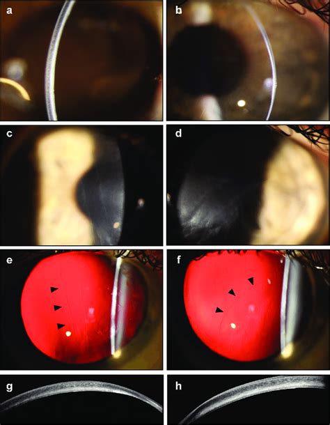 Slit Lamp Photographs Of The Right A C E And Left B D F Eyes Of