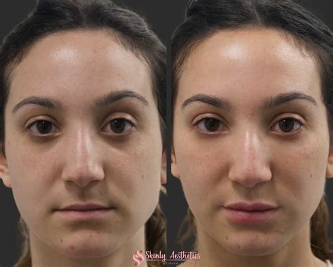 Under Eye Fillers Before After Results At Skinly