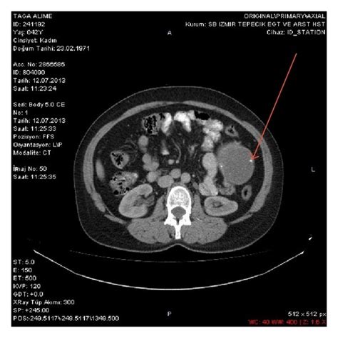 A The Coronal CT Image Of Bilobar Hydatid Cyst Lesion B The