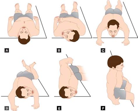 Barbecue Rotation Technique According To Lempert For Right Lsc Bppv