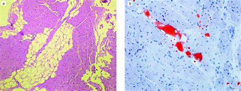 Right Ventricular Dysfunction In Rheumatic Heart Valve Disease A