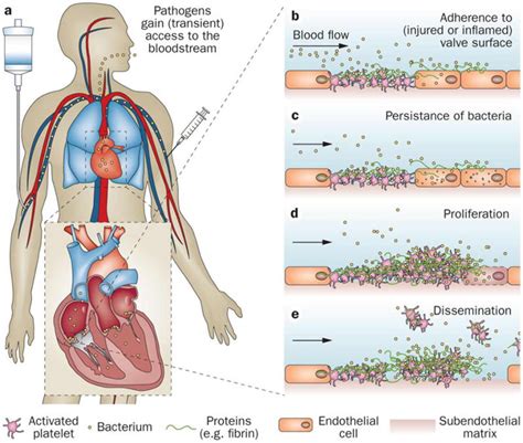 Infective Endocarditis Causes Signs Symptoms Diagnosis And Treatment