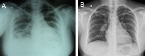 Isolated Pulmonary Valve Endocarditis A Case Report And Review Of Literature Journal Of