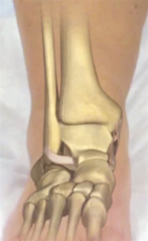 Ankle Dislocation Diagram