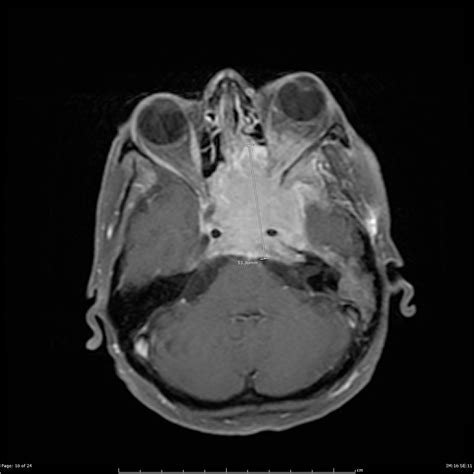 Skull Base Meningioma With Infratemporal Extension Image