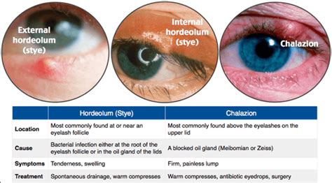 Chalazion In Eye: Causes, Surgery & Home Remedies - Health Blog