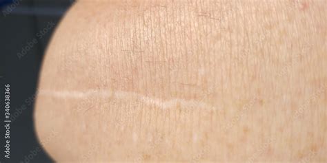 Scar on knee after knee replacement surgery Stock Photo | Adobe Stock