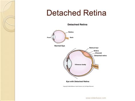 Retinal Detachment