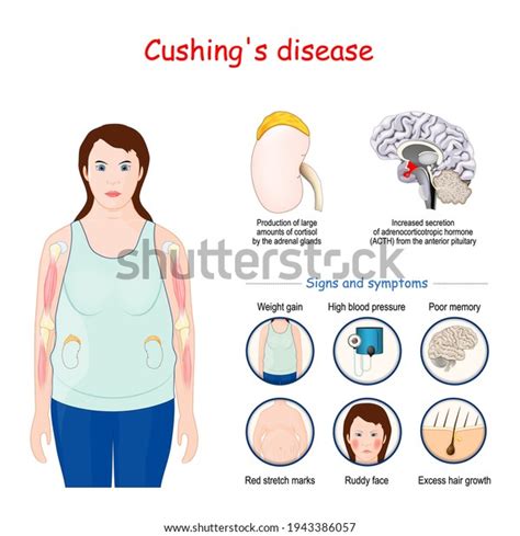 Cushings Disease Signs Symptoms Cushing Syndrome Immagine Vettoriale