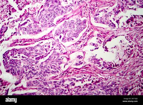 Lung Adenocarcinoma Light Micrograph Photo Under Microscope Stock