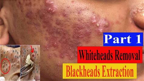 Cystic Acne Extraction This Week Blackheads Removal Blackhead