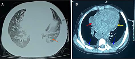 CT scan of chest. (A) The lung window showing scattered infiltrates in... | Download Scientific ...