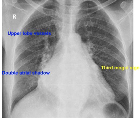 Double Atrial Shadow And Prominent Upper Lobe Vessels All About