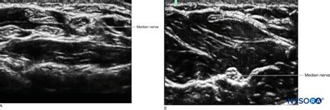 Introduction to Ultrasound-Guided Regional Anesthesia - NYSORA