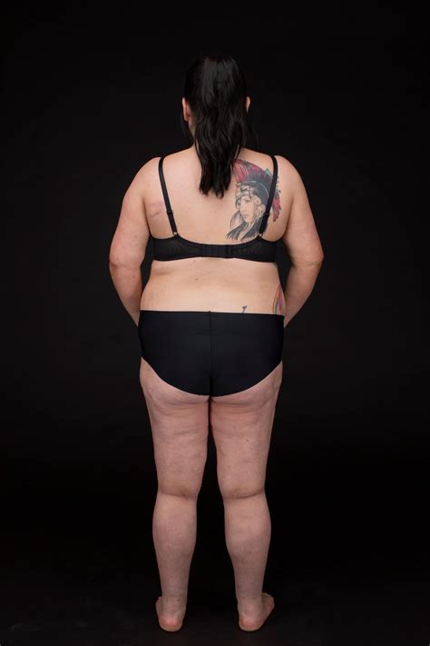 What Does Lipoedema Look Like? — Lipoedema Australia