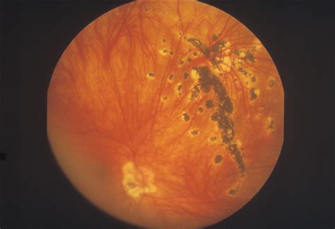 Panoramic Imaging Of The Ocular Fundus Cataract And Other Lens